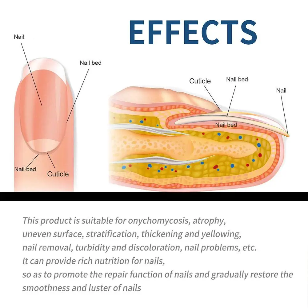 Remendo de tratamento de paroníquia, remoção de fungos, adesivos de correção de unhas encravadas, recuperação de unhas, ferramenta de cuidados de pedicure, 1/2/3 pacotes