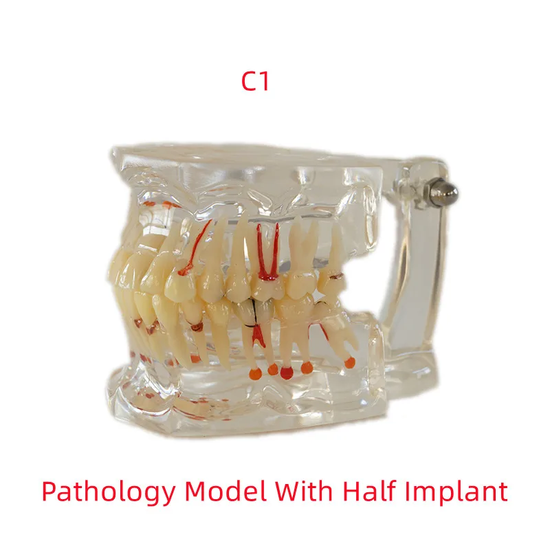 Model nauczania stomatologicznego Model patologii z pół/pełnym implantem C1/C4 dentysta narzędzia laboratoryjne