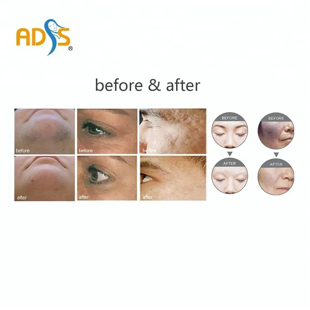 2025/ADSS 4S نظام الإضاءة الذكي IPL + E Light + و YAG آلة إزالة الشعر متعددة الوظائف آلة IPL المحمولة