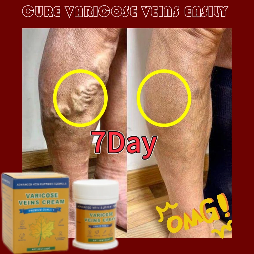 Varicose vein cream relieves itching and pain