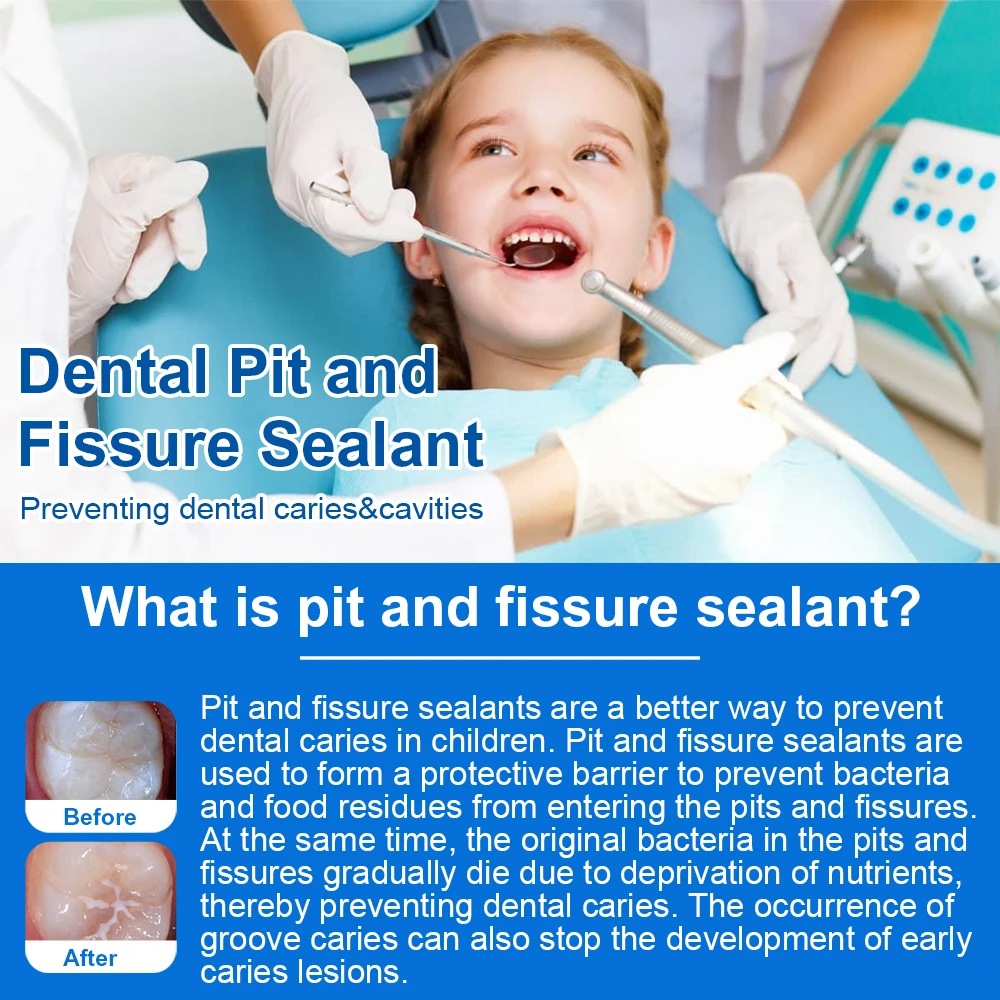 Mastic pour fosses et fissures dentaires, matériel de protection au fluorure à photopolymérisation, outils dentaires, consommables dentaires