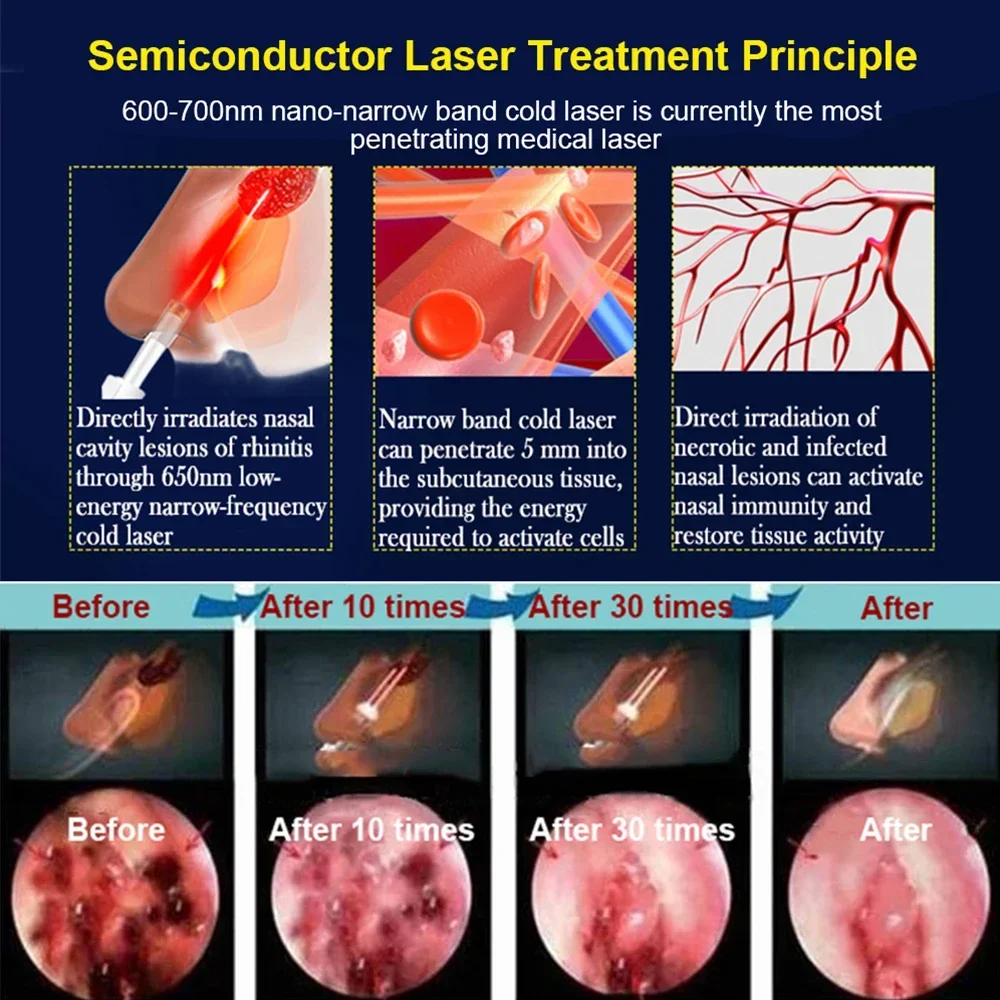 Cuidados com o nariz rinite sinusite cura terapia bionase massagem febre do feno pulso de baixa frequência laser nariz máquina de cuidados de saúde atacado