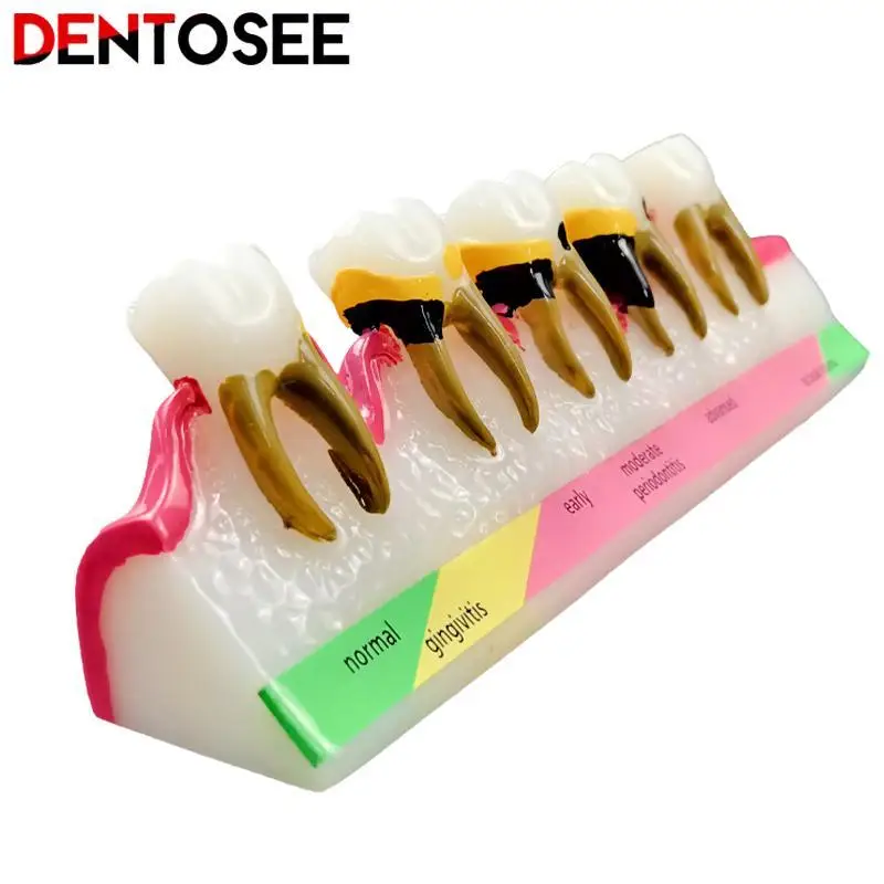 

Dental Periodontal Disease Assort Demo Teeth Model 5 Stage Three-Dimensional Proportional Magnification Design for Dentist