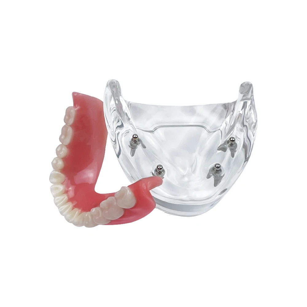 Lower Dental Implant Model For Education Teaching Studying 4 Implants Removable Restoration Bridge Overdenture Model Transparent