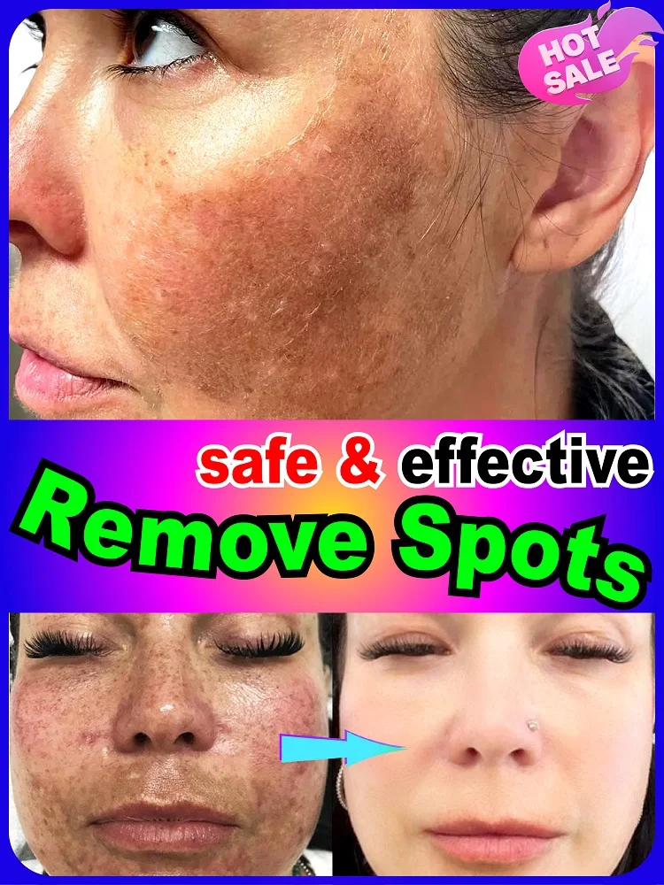 

Solve all pigmentation dark spots symptoms