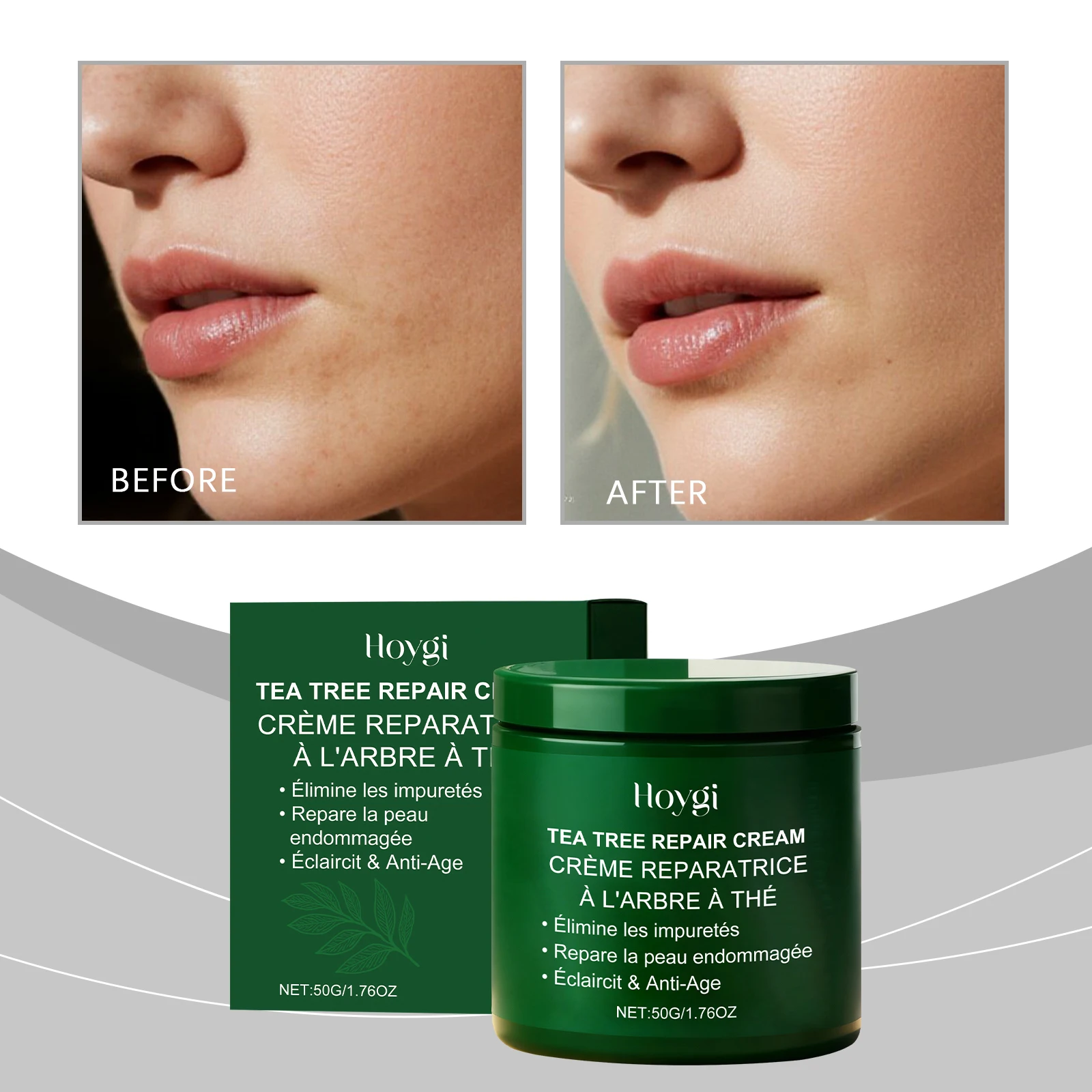 ホイギ ティーツリー フェイシャルクリーム - ニキビができやすい、脂性肌のためのディープピュリファイング、ブライトニング＆リバイタライジング モイスチャライザー、スキンケアトリートメント