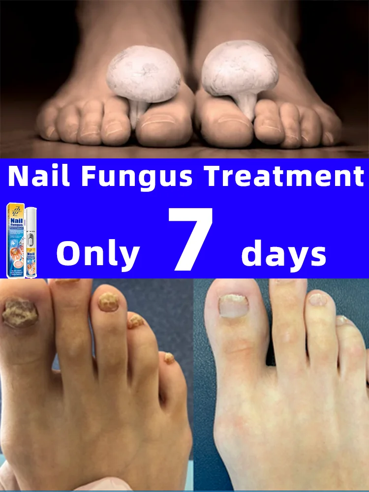 Nᴏ sɪᴅᴇ ᴇғғᴇᴄᴛs, ᴇғғᴇᴄᴛɪᴠᴇʟʏ ʀᴇᴍᴏᴠᴇs ɴᴀɪʟ ғᴜɴɢᴜs