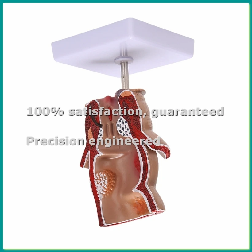 

Анатомическая модель: Модель патологических изменений в прямой кишке человека (фистула, фисура) для обучения - ABFT