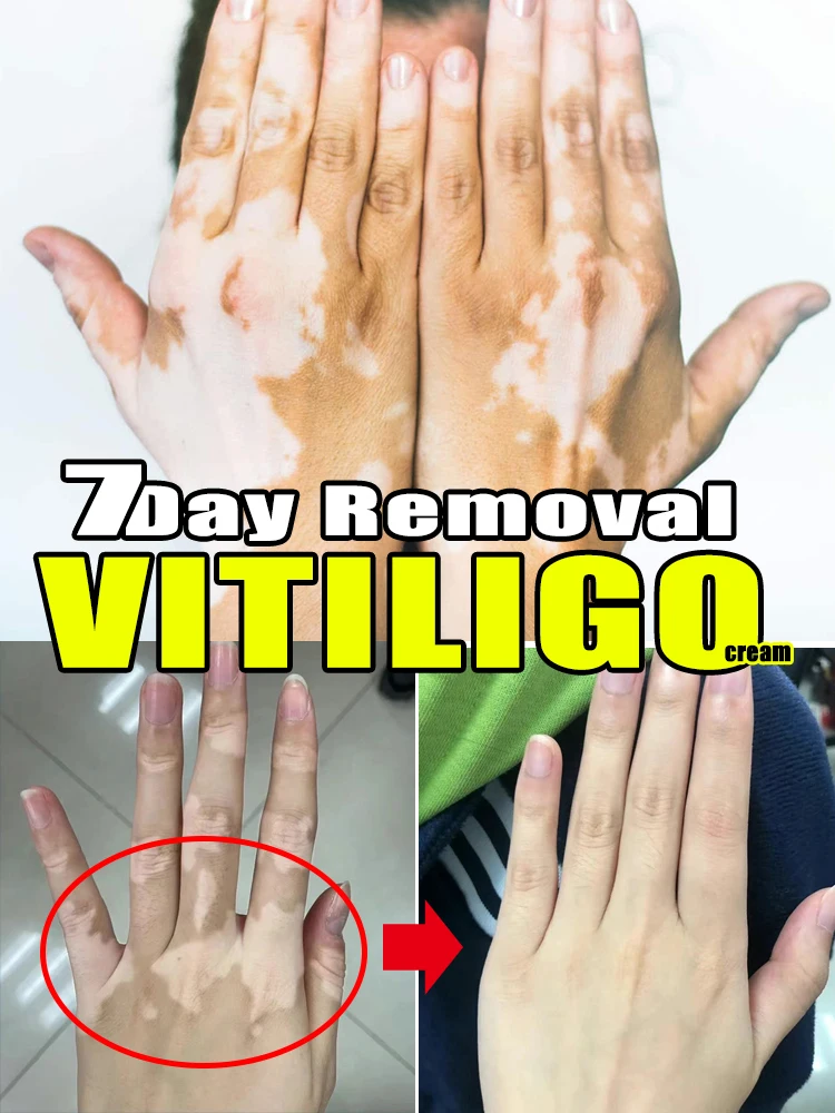 

Vitiligo ointment is effective in repairing the skin