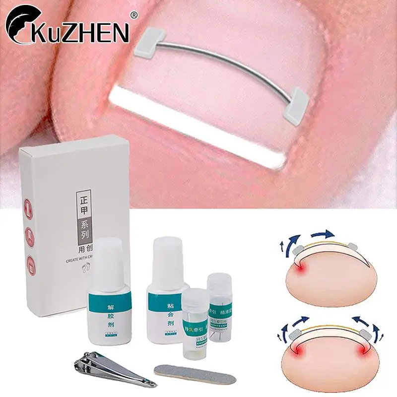 

1Set Ingrown Toenail Corrector Tools Pedicure Recover Embed Toe Nail Treatment Ingrown Toenail Correction Foot Care Tool