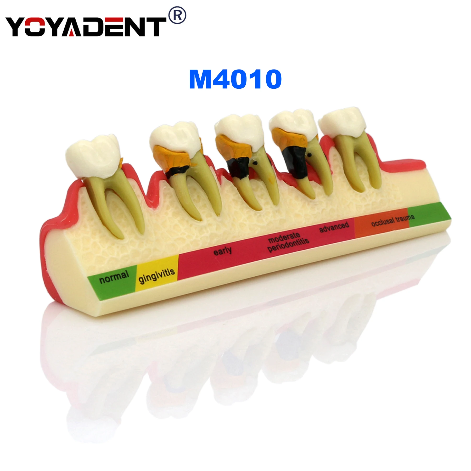 

Dental Teeth Model 5 stages gingivitis/periodontal Model Cross-sectioned model Dentists Teaching Demo