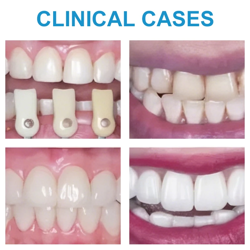 XANGTECH Neue 5 Stück Lithium-Disilikat-Blöcke C14 Glaskeramik Dentallabor für Sirona Cerec CAD/CAM für Kronenfurniermaterial