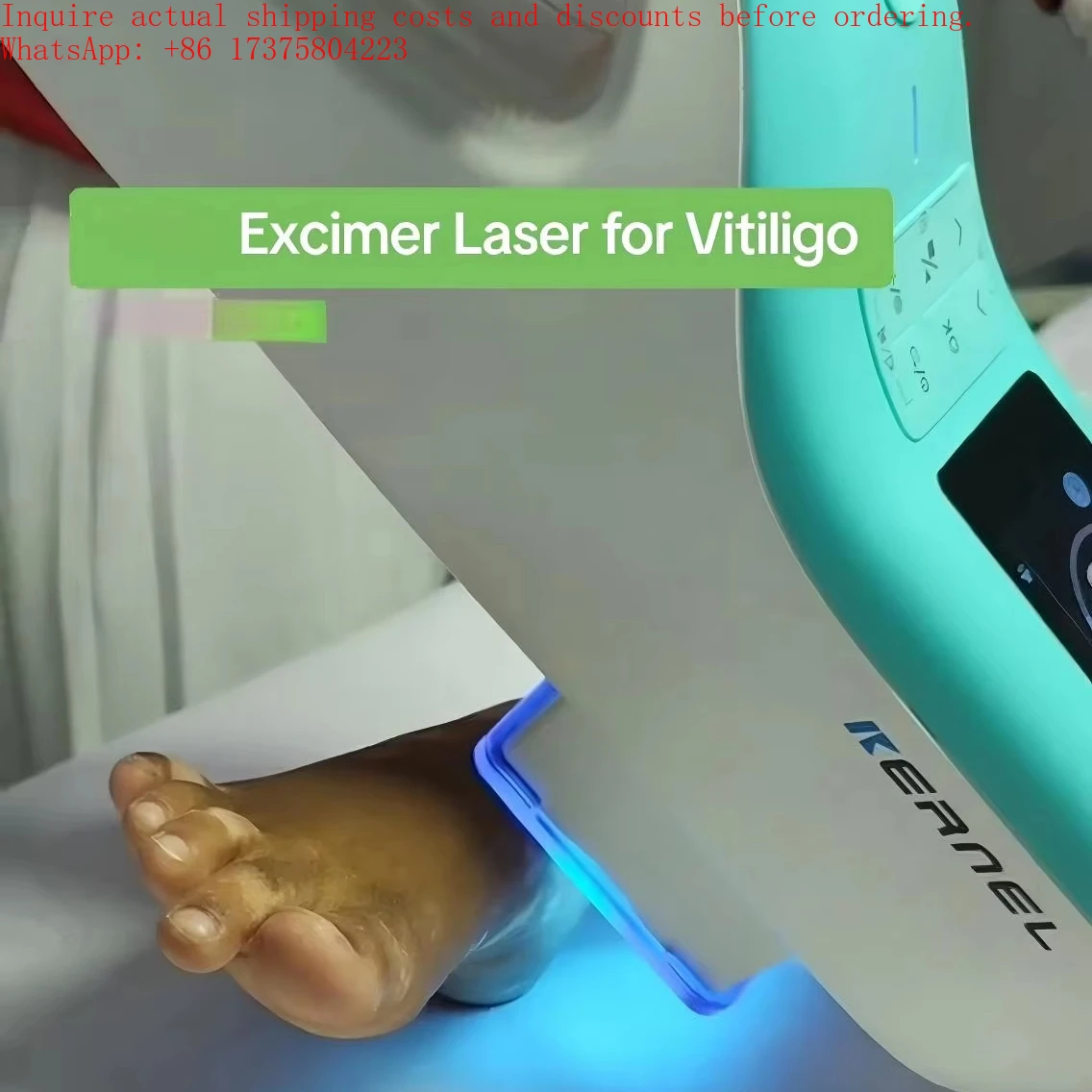 Kernel Handheld 308 Targeted High Intensity and Precision UV Light for Severe Psoriasis and Vitiligo