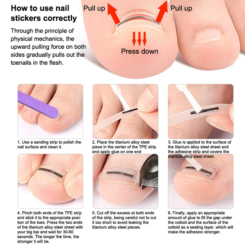 Strumento per la protezione delle dita dei piedi per la correzione dell'unghia del piede incarnita Adesivo per il trattamento delle unghie Strumento per pedicure della paronichia