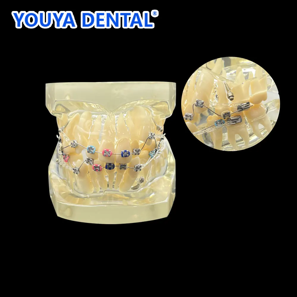 

Ortho Metal Bracket Model Orthodontic Treatment Teeth Model Standard Malocclusion Demo With Metal Brackets Doctor-patient