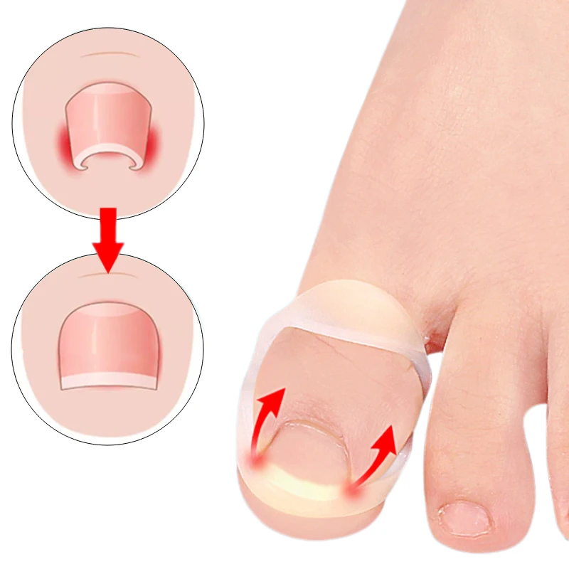 10Pcs Gel Ingrown Toenail Correction Invisible Ingrown Toe Nail Treatment Elastic Straightener Clip Brace Foot Care Pedicure