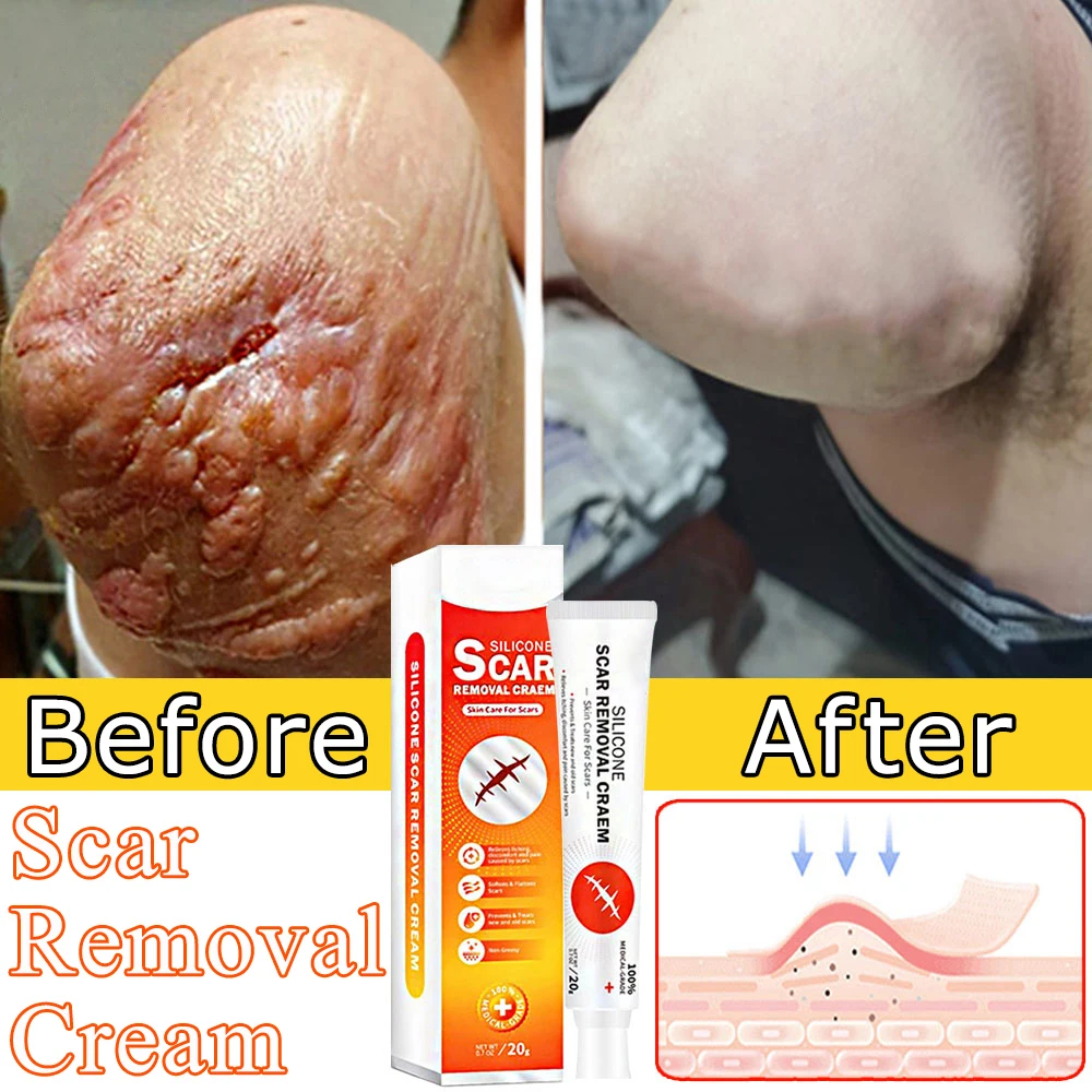 Scar Removal Cream Remove Acne Spots Treatment Stretch Marks Burn Surgical Scar Smoothing Whitening Pigmentation Care