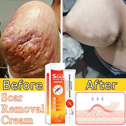 Scar Removal Cream Remove Acne Spots Treatment Stretch Marks Burn Surgical Scar Smoothing Whitening Pigmentation Care