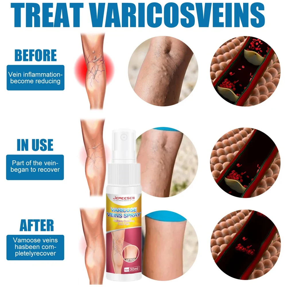 Jemeesen Varicose Vein Spray Relieve Legs Dilated Vasculitis Phlebitis Natural Formula Liquid For Varicose Veins Body Care 30ML