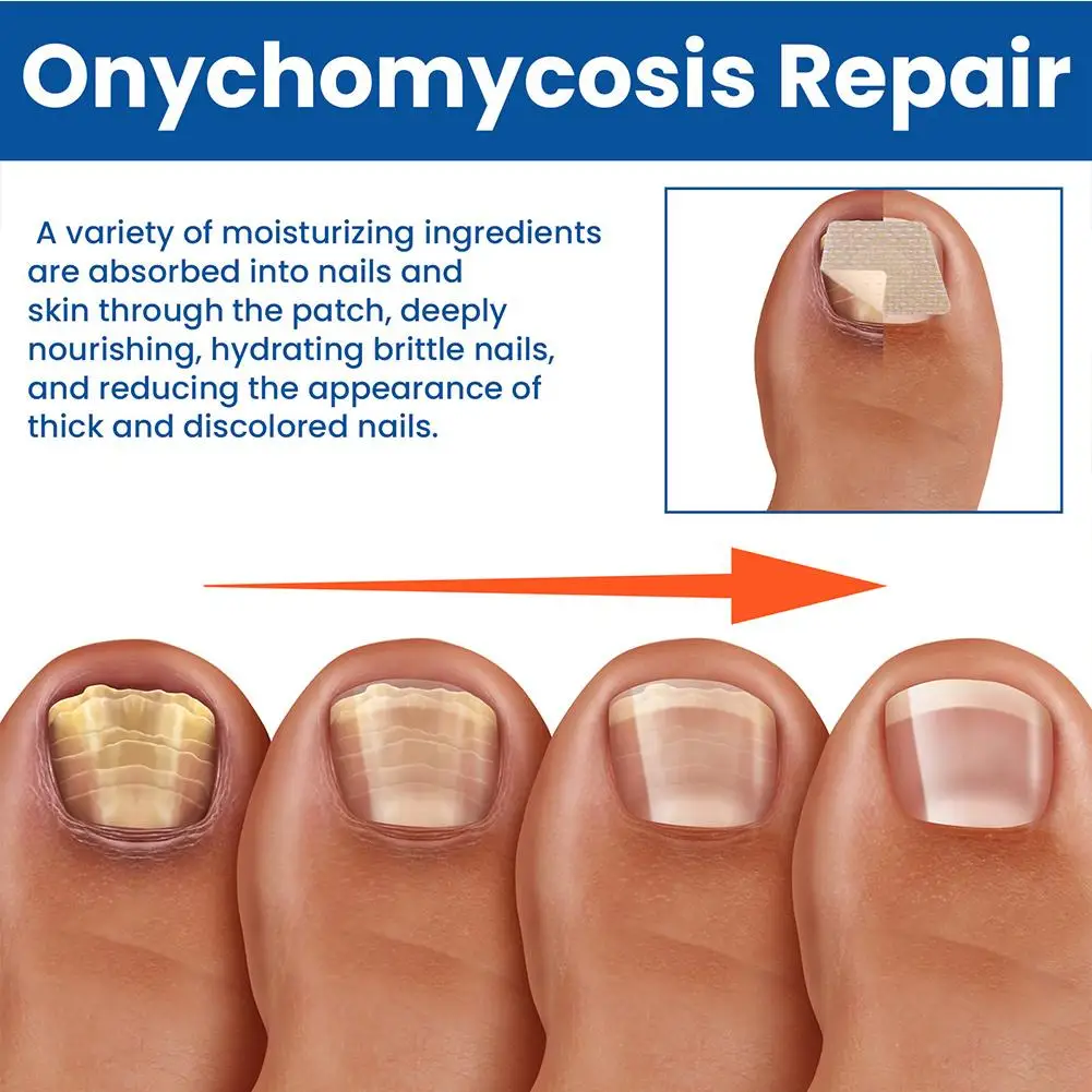 2x ป้องกันการติดเชื้อเล็บ Patch Onychomycosis กําจัดเล็บสีเทาซ่อมลบเชื้อราคุด Toenail Care Paronychia Treatment Stic