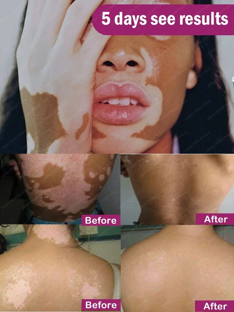 Vitiligo- White Spots Blue Light Lase Technology