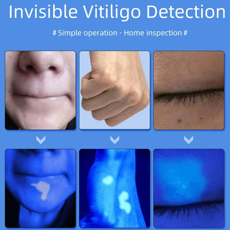 Lampe en bois pour analyseur de peau, lampe ultraviolette UV pour examen de la peau, Test de beauté, grossissement du visage, lampe Vitiligo