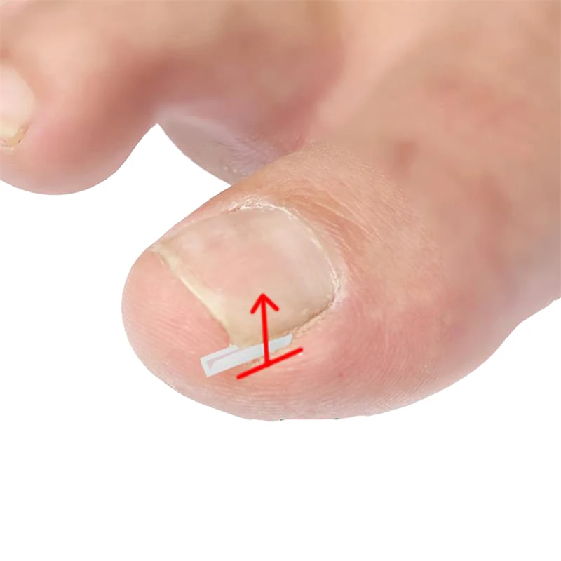 10 pezzi di correzione delle unghie dei piedi incarnite filo fissatore pedicure paronichia recuperare le unghie dei piedi correttore strumento per la cura del piede raddrizzamento