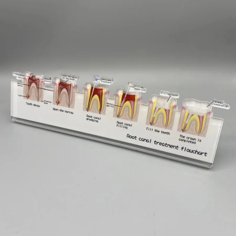 Stomatologiczny schemat blokowy leczenia kanałowego stanowi dla laboratoriów dentystycznych gabinet dentystyczny Model nauczania dentystyczny