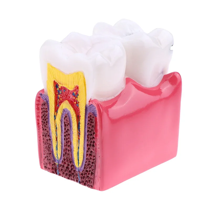 

6-кратная модель кариеса, заболевания зубов, стоматологическая модель для стоматологической демонстрации, модель стоматолога, обучение, стоматологическая лаборатория, исследование полости рта