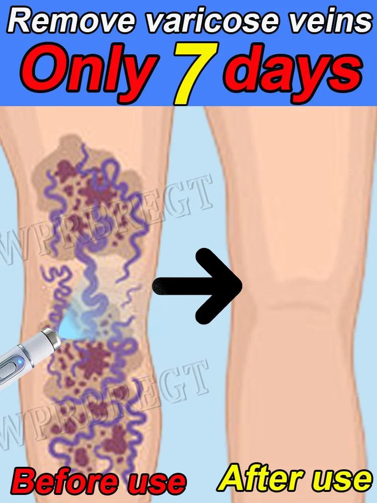 

Laser quickly removes varicose veins and dilated veins to promote blood circulation after long periods of sitting