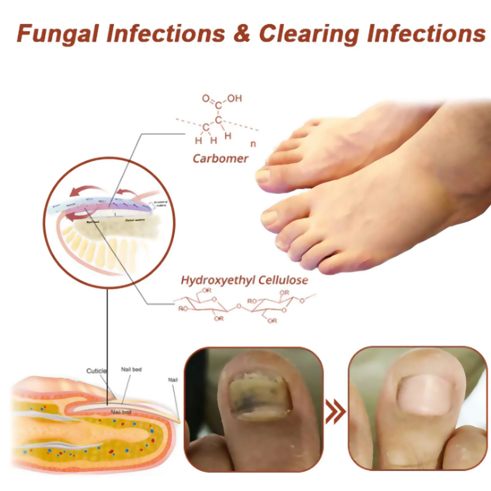 เชื้อราอุปกรณ์เลเซอร์เล็บซ่อมแซมเล็บอย่างรวดเร็วเชื้อรา Onychomycosis