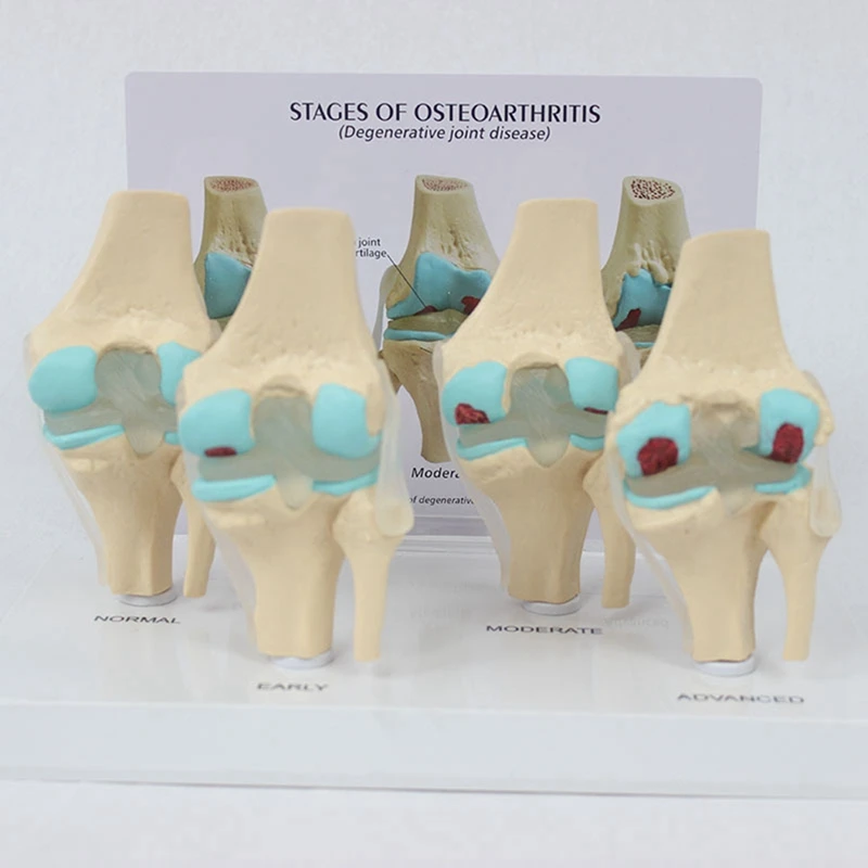 NEW-Knee Kit Osteoarthritis Anatomy Model With Educational Key Card 4 Stage Knee Model Orthopedic Teaching Aids