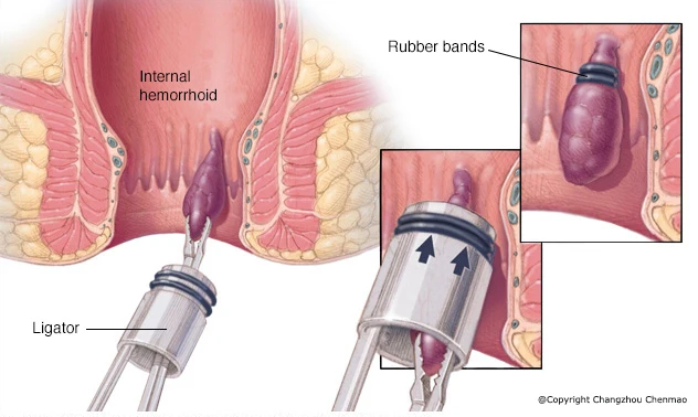 Jednorazowego użytku hemoroidy wielopasmowa ligatura z anoskopem