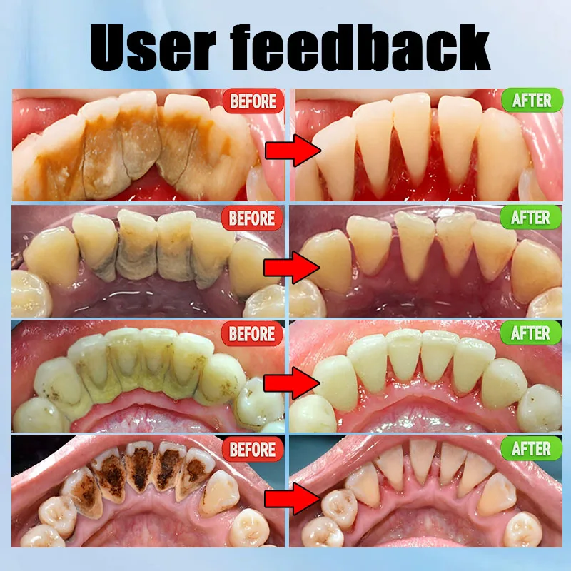 Sbiancamento dei denti per la rimozione del calcolo dentale Spedizione gratuita