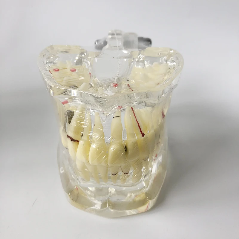 Dental M4001 Erwachsenen modell mit Pathologien Zahnarzt Training Zähne Modell