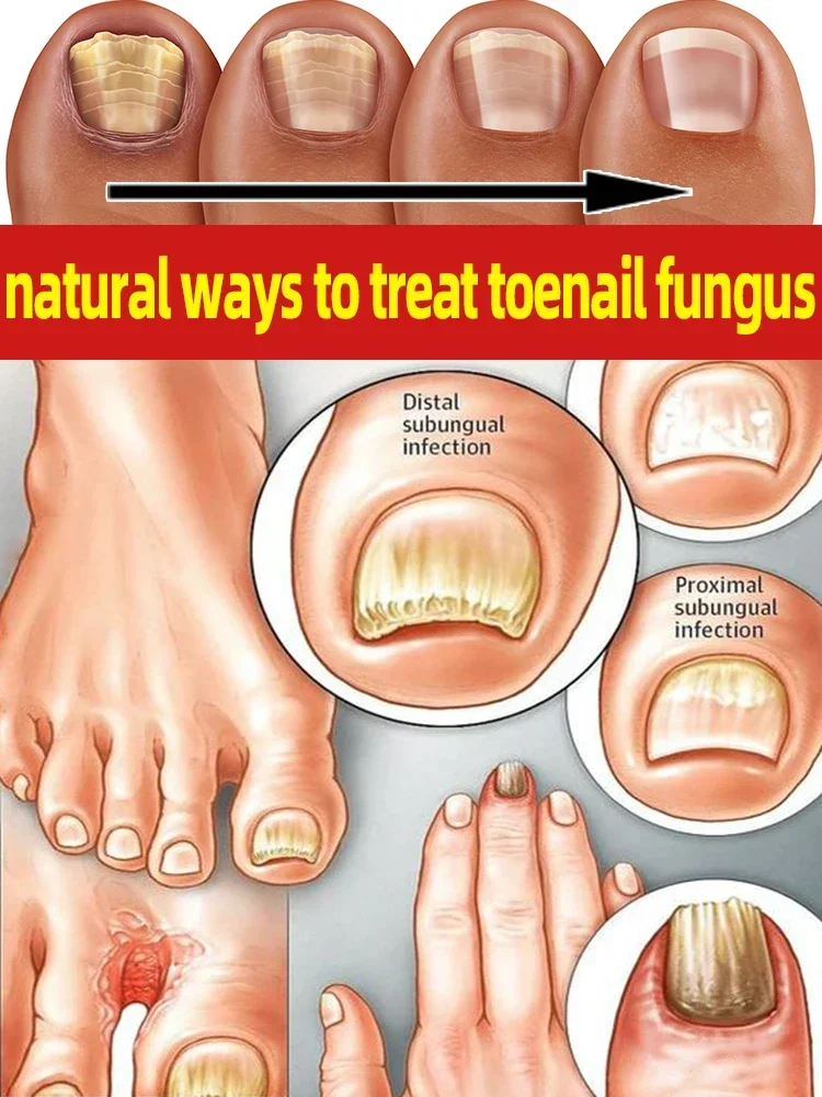 

Laser Product For Solving Nail Problems