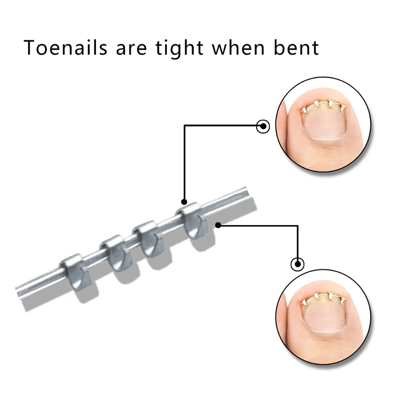 1PC Front Nail Hook Band Nail Ingrown Toe Nail Correction Toenail Nail Ingrown Clip Orthosis Paronychia Tools
