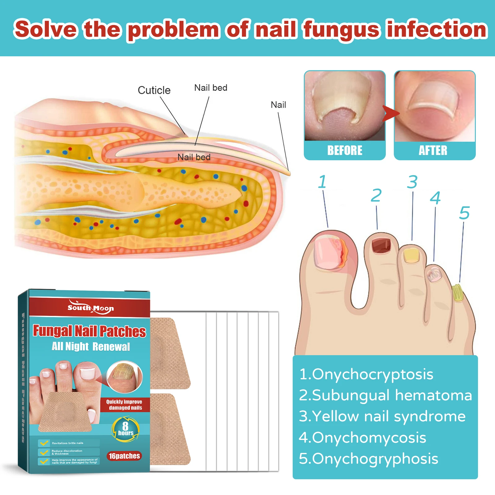 16PCS Toenail Fungus Treatment Stickers Ingrowning Toenail Corrector Paronychia Repair Patch Fungus Removal Nail Care Products