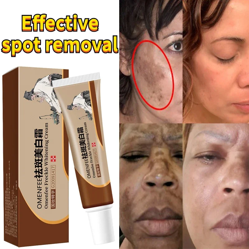 

Effective Whitening Freckles Cream Remove Dark Spots Fade Melanin Anti-Pigmentation Improve Dullness Fast Brighten Skin Care 20g