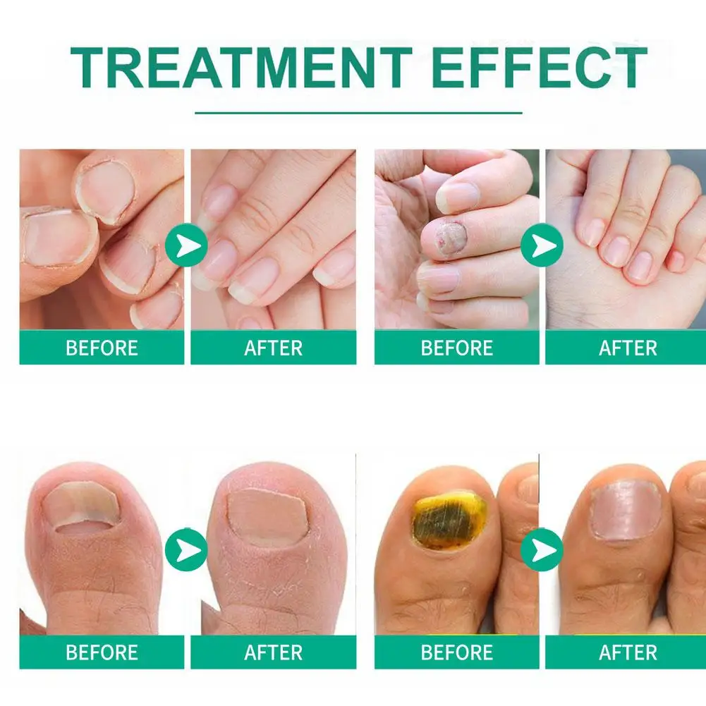 5pcs Extra Strong Nail Fungus Treatment Serum Essence Oil Care Repair Essence Anti Toe Infection Gel Feet Cream Removal Nails