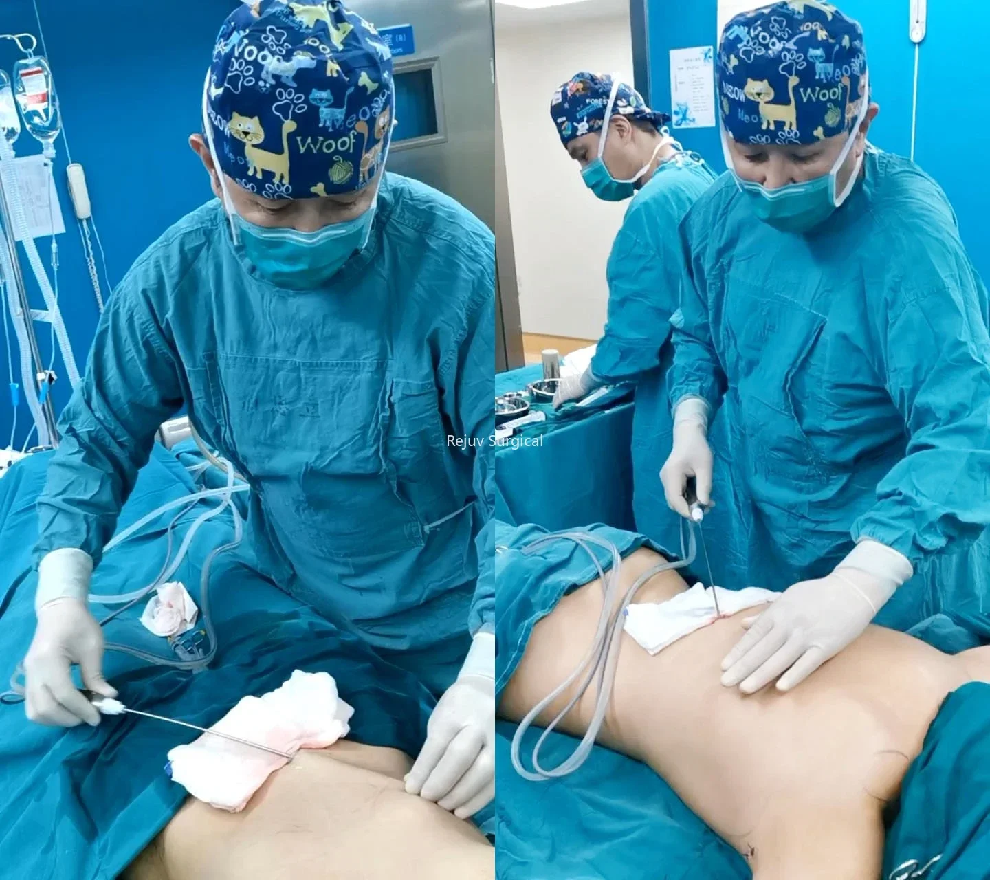 Sistema Lipo Vaser assistito ad ultrasuoni SonicMed Liposcultura cinese per liposuzione Vaser 120 W approvato da CFDA