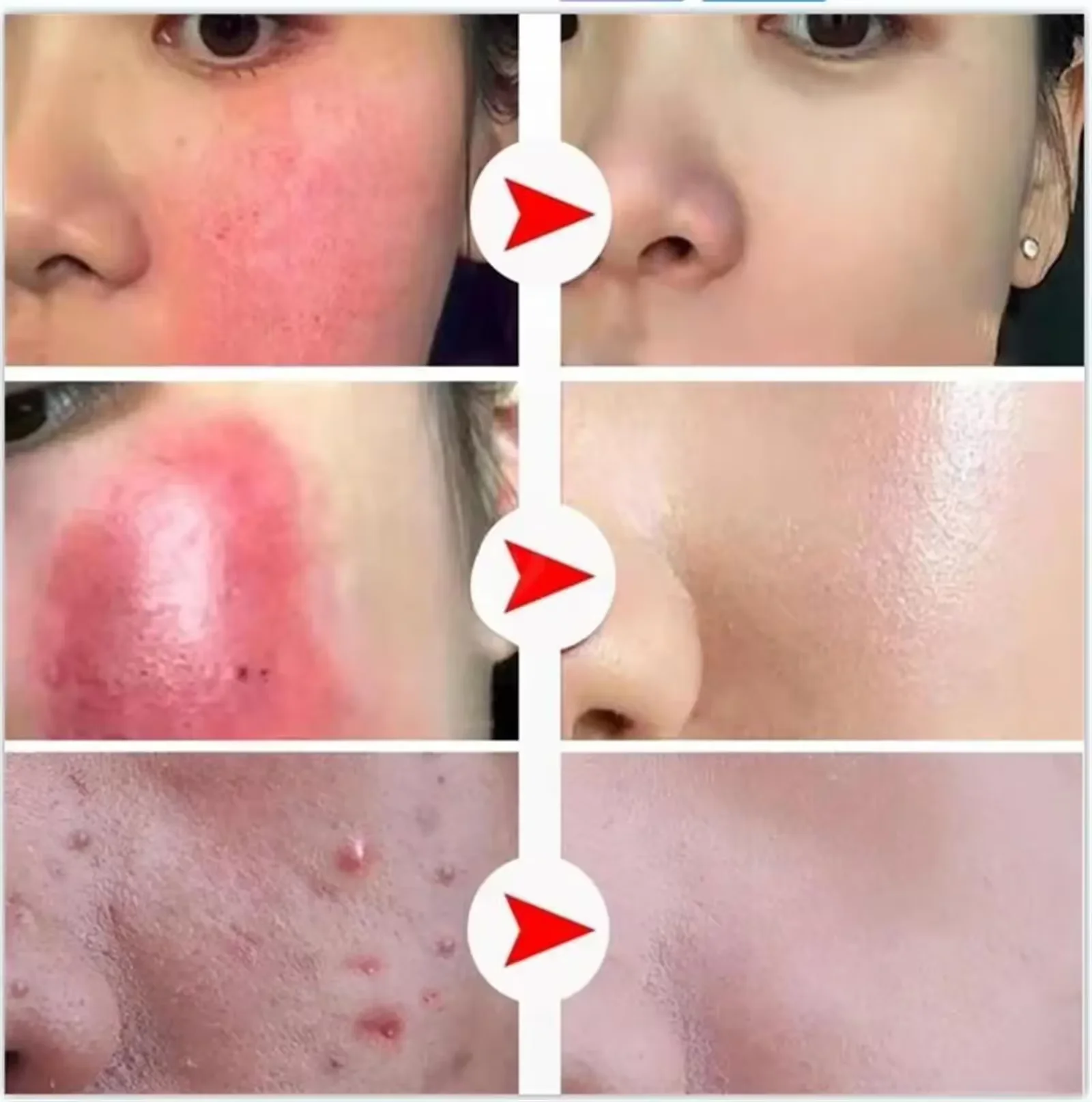 Repair Facial Redness Cream Instant Spider Vein Remove Sensitive Skin Sooth Anti Redness Rosacea Treat Lotion Korean Cosmetics