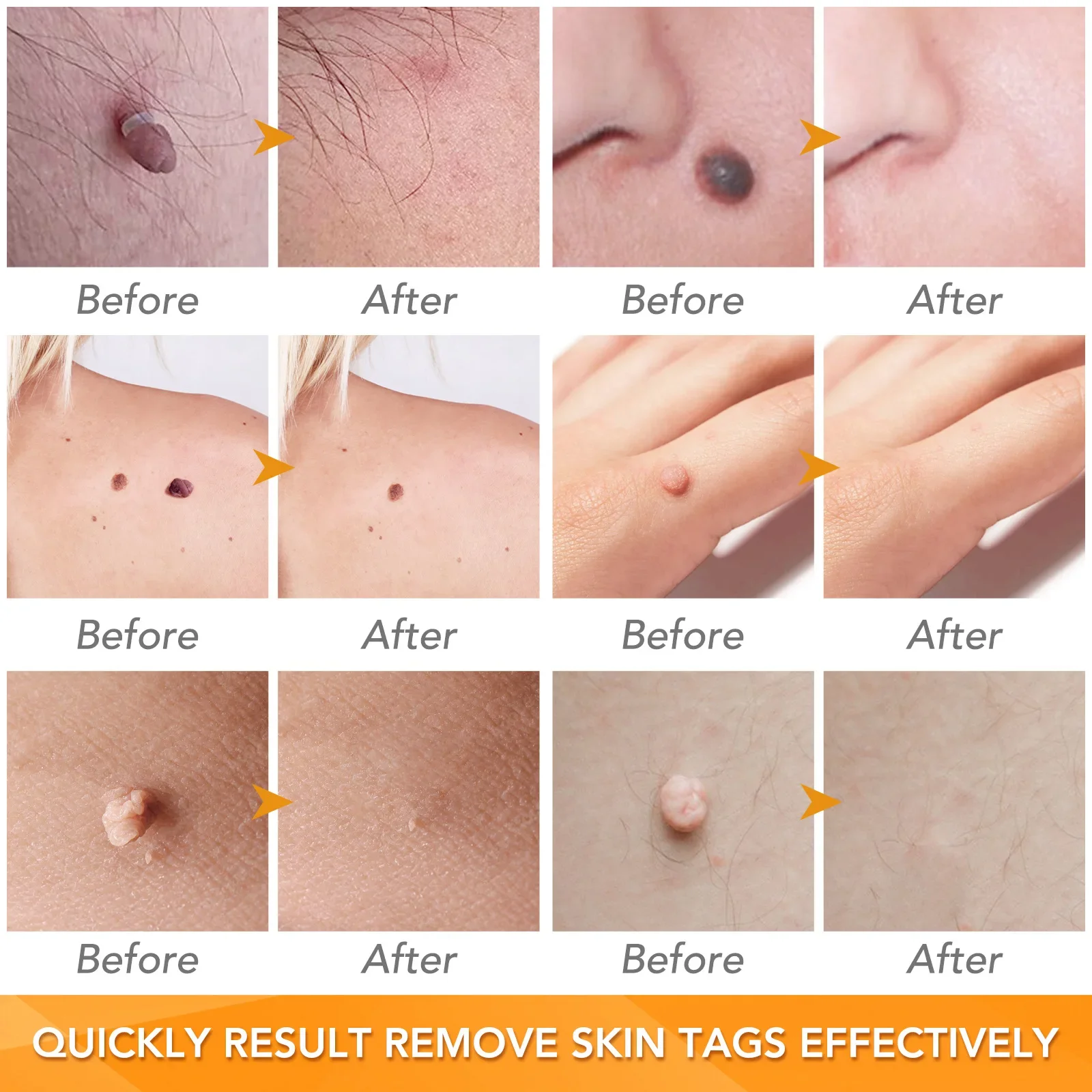 Simple Wart Removal Tool Set Skin Tag Removeal Tool Easy To Clean Skin Care Tool Skin Tag Removal Care Products