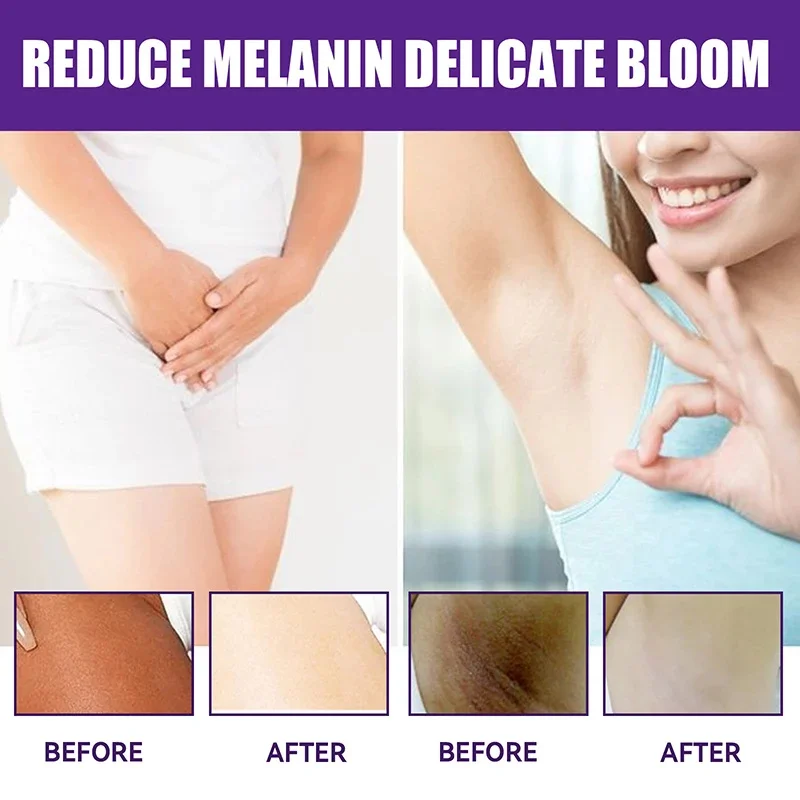 Whitening Cream Private Parts Underarm Bleaching Whiten Butt Knee Brighten Inner Thigh Intimate Parts Dark Remove Melanin Care