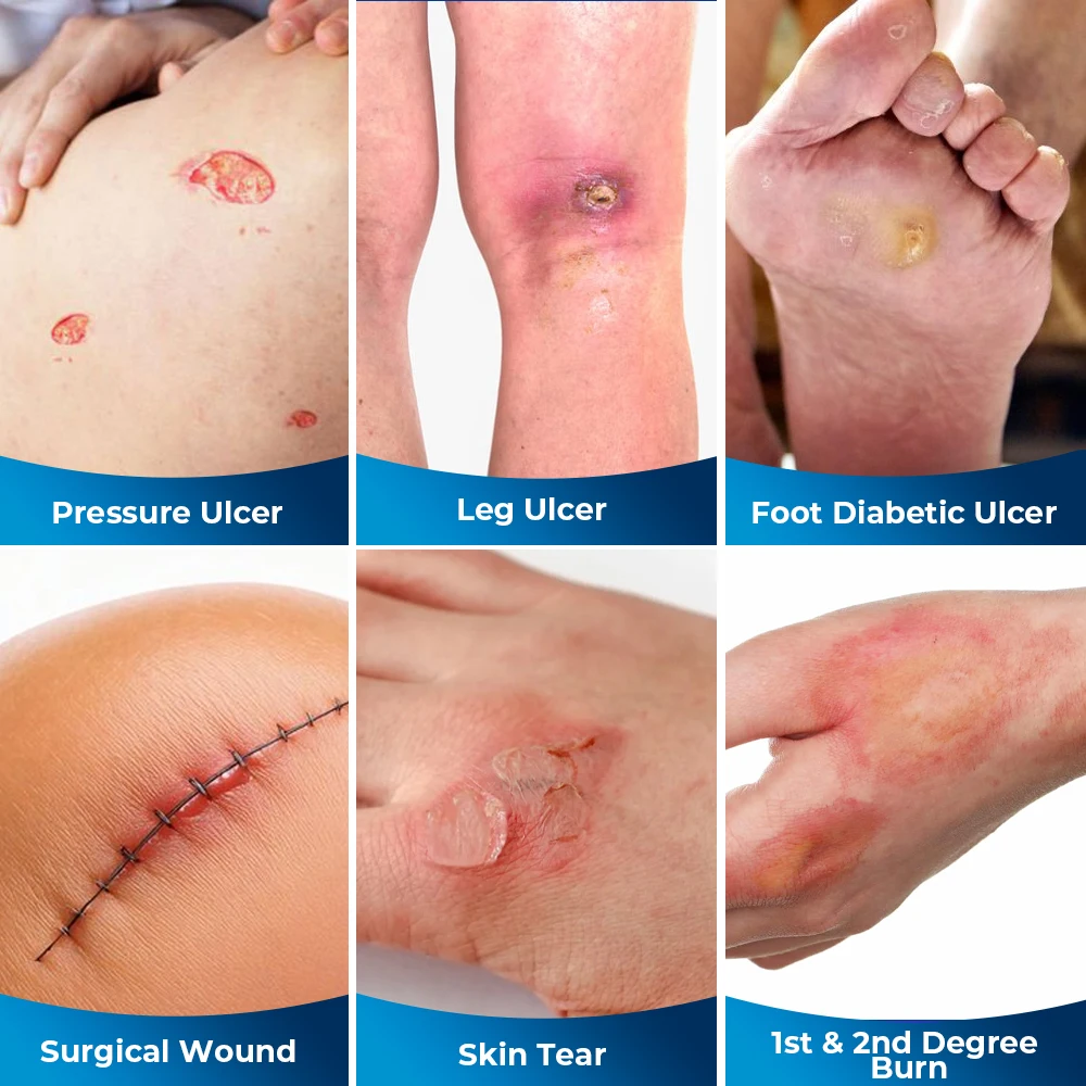 5 قطعة رغوة السيليكون خلع الملابس مقاوم للماء مضاد للجراثيم مكافحة العدوى لينة الجلد ودية Sacrum لاصق خلع الملابس المنزل الإسعافات الأولية #4