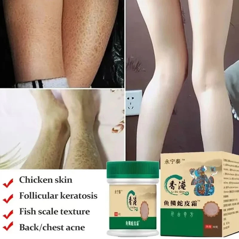 Chicken Skin Removal Treatment Body Cream Dilute And Remove Dead Skin Cell Pore Spot Dull Whitening Moisturizing Body Care Cream