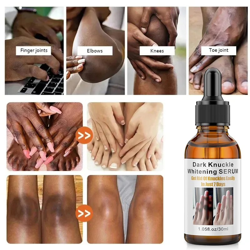 ﻿ Black Skin Remover Essence Elbows Hand Dark Knuckle Fast Brightening Serum Lightening Glow Recipe Skincare Body Products