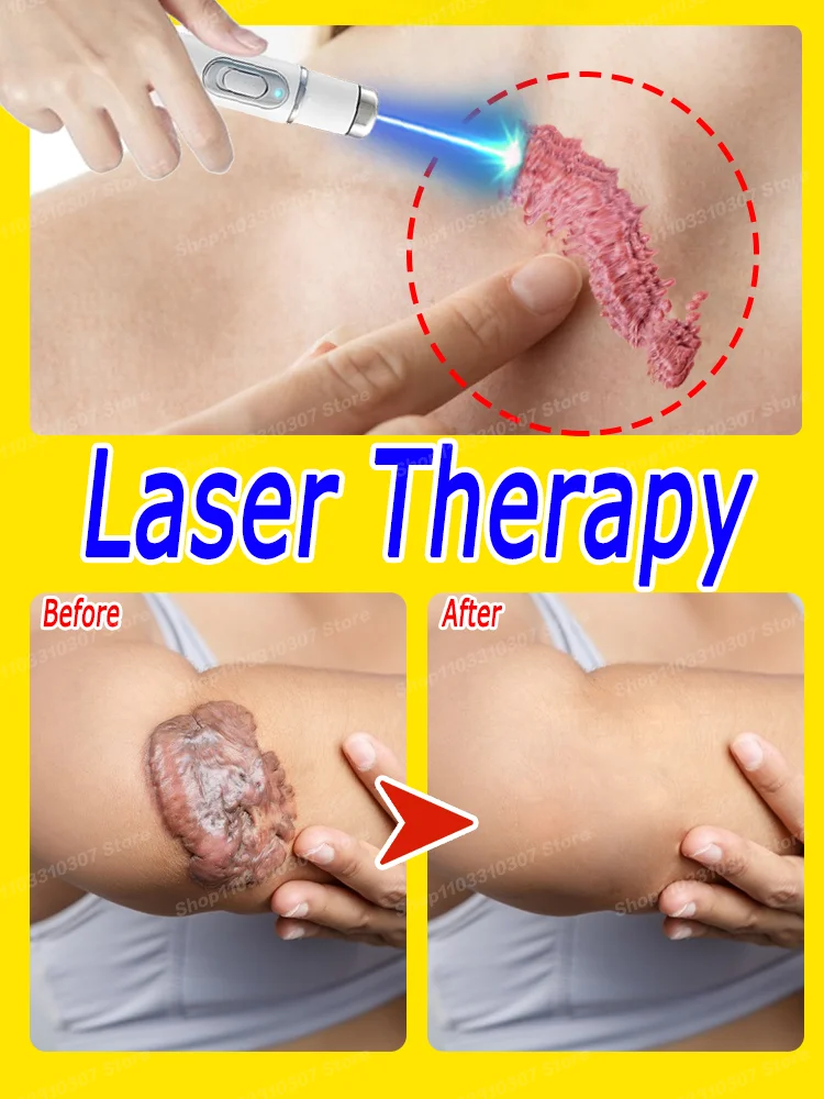 

Лидер продаж, портативная ручка с синим светом, защищает лицо, очищает, безболезненный лазер, удаляет шрамы, следы от прыщей
