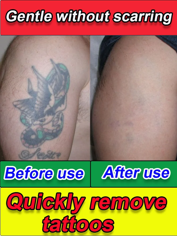 

Fast and safe tattoo removal, painless removal of permanent tattoos