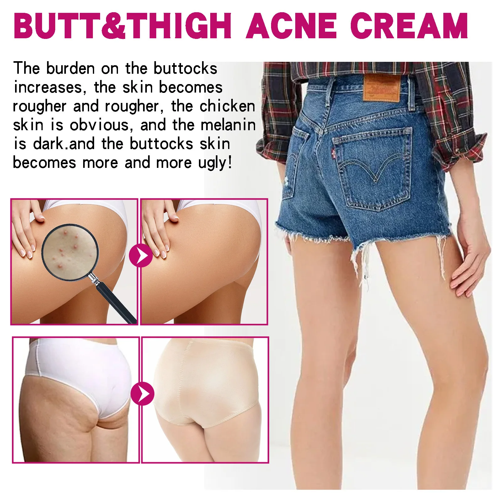 Women's Body Acne Treatment Cream Repair Dark Spots Acne Moisturizing Lotion Hip Inner Thigh Bleaching Essence Hip Cream